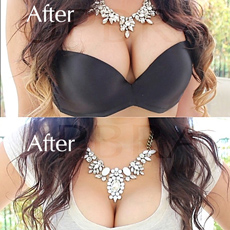 Upbra comparisons of before and after